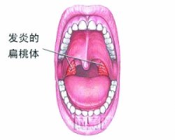 盘点小儿扁桃体肥大的五大症状